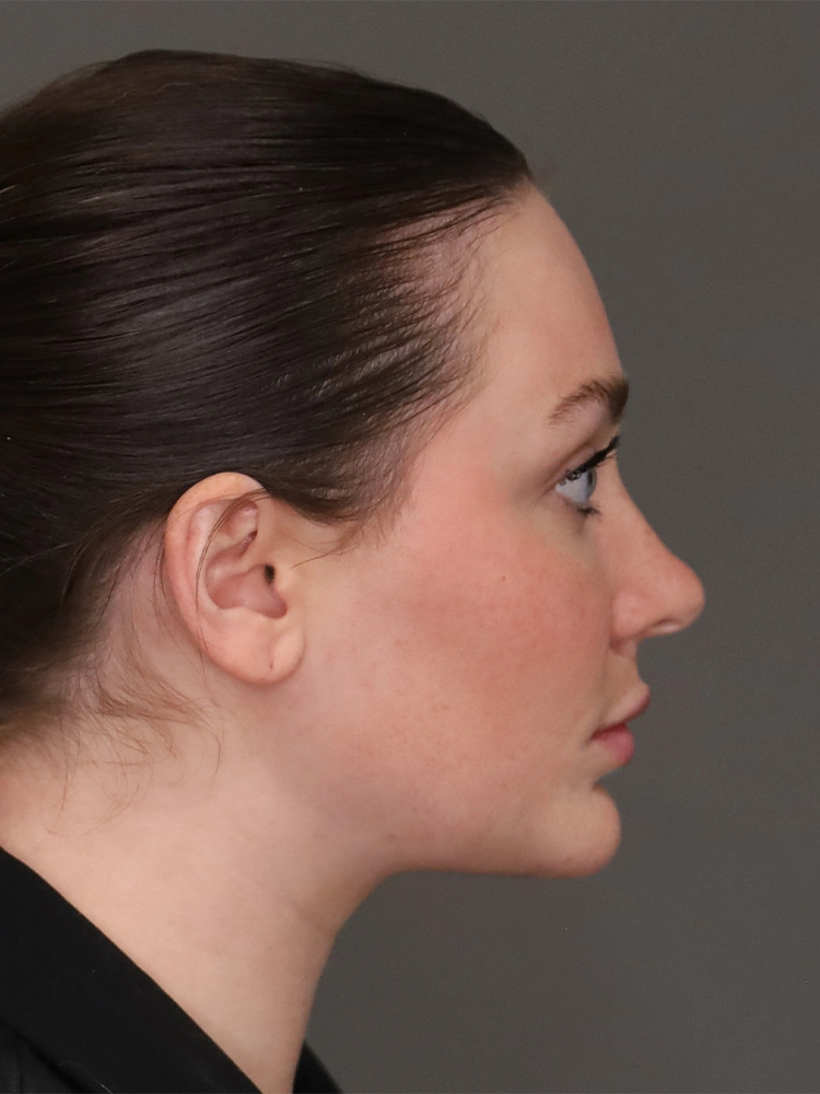 Neck Lift Post Lateral