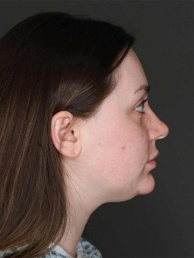 Neck Lift Pre Lateral