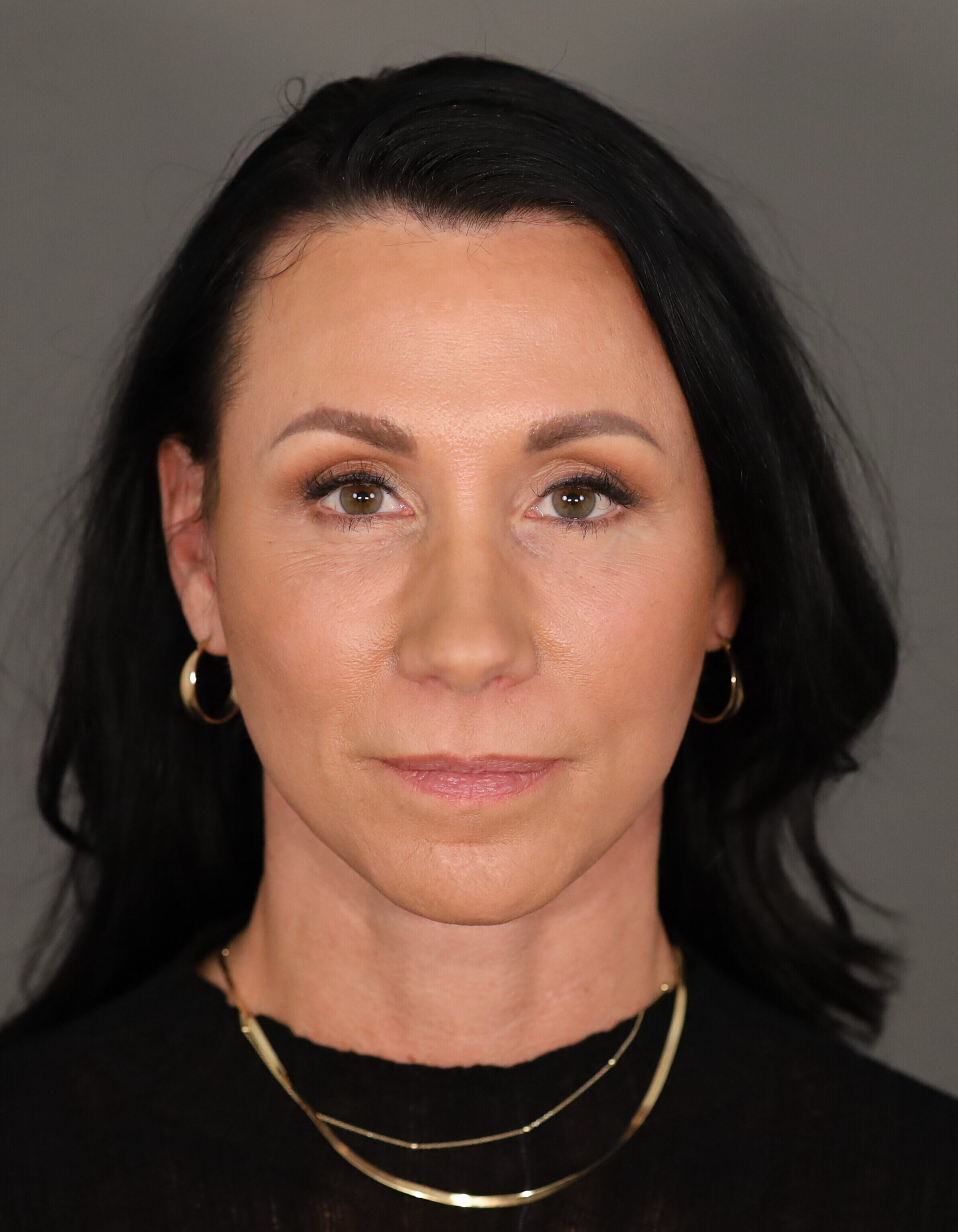 Cantera Frontal Post