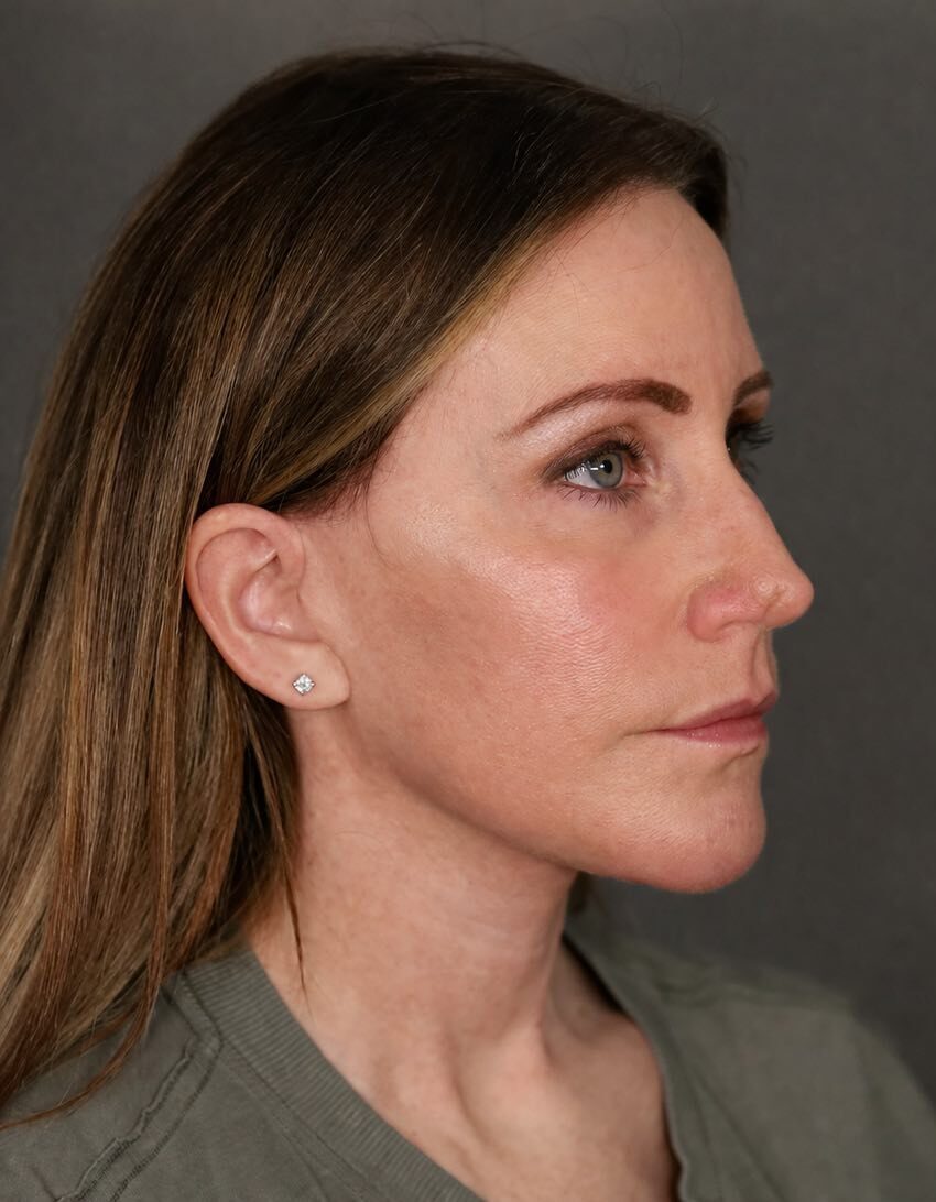 Metcalf Lateral Post